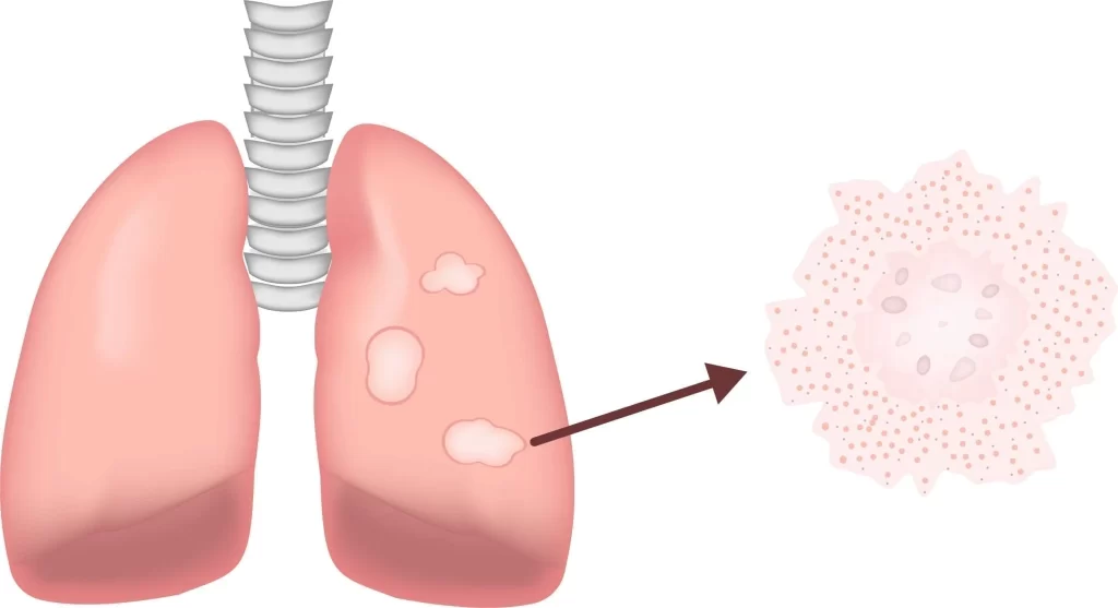 Sarcoidosis and pulmonary fibrosis