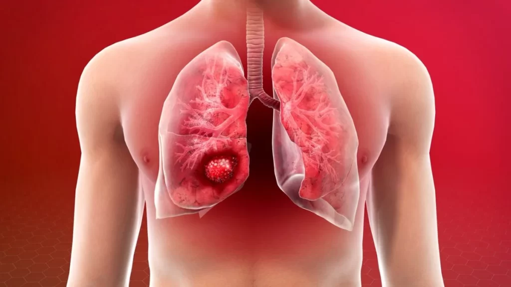 What is lung cancer, and how is it treated?