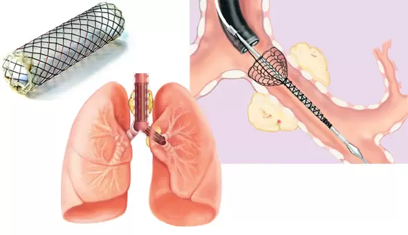 What are the possible 
?complications of stenting