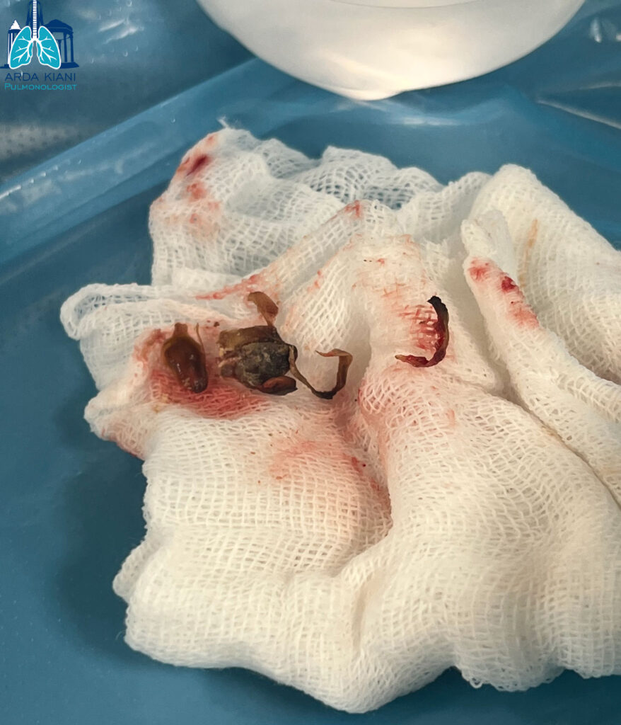 خارج کردن جسم خارجی 3