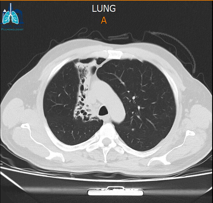 برونکوسکوپی ریه 2
