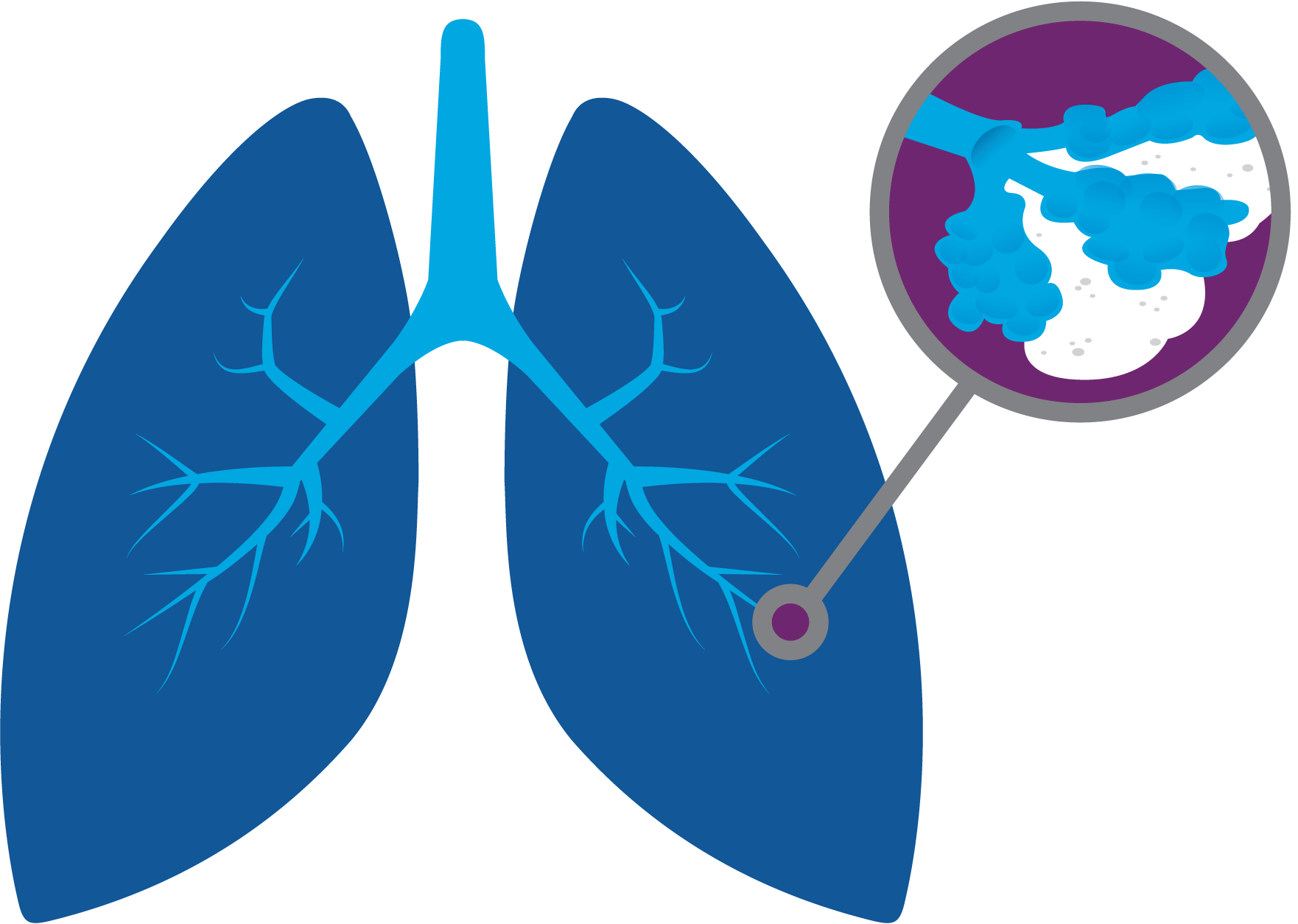 آیا فیبروز ریه خطرناک است؟