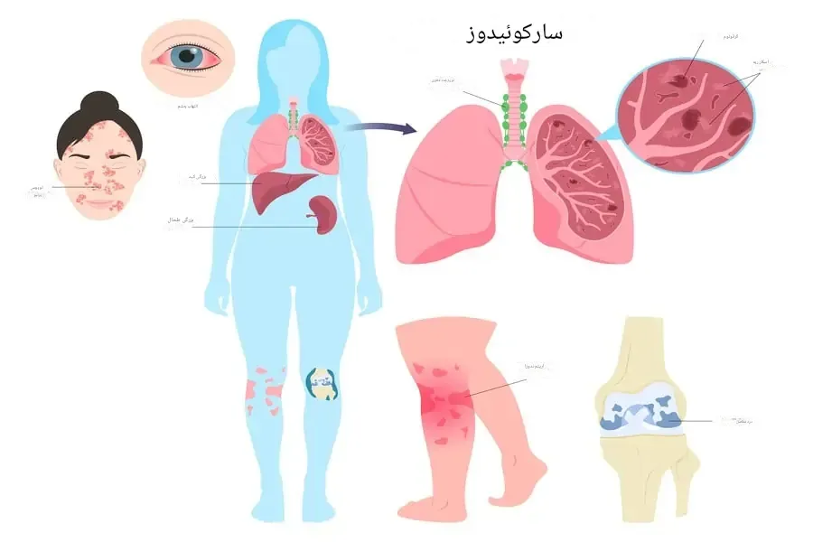 سارکوئیدوز