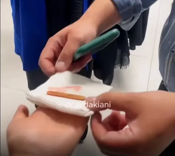 خروج چوب بستنی از ریه کودک 5 ساله