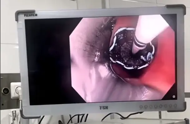 سوراخ شدن مری بعد از 17 بار آندوسکوپی