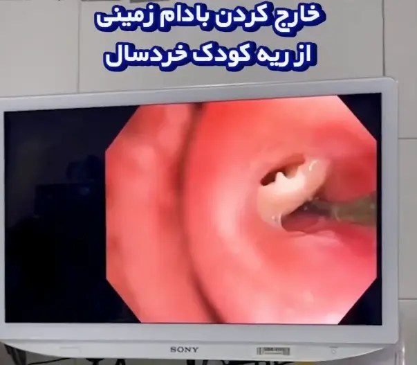 خارج کردن بادام زمینی از ریه کودک خردسال