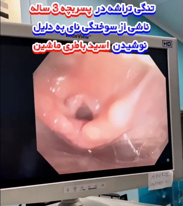 تنگی تراشه در پسر بچه 3 ساله ناشی از سوختگی نای به دلیل نوشیدن اسید باطری ماشین