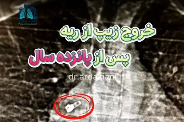 خروج زیپ از ریه بعد از 15 سال