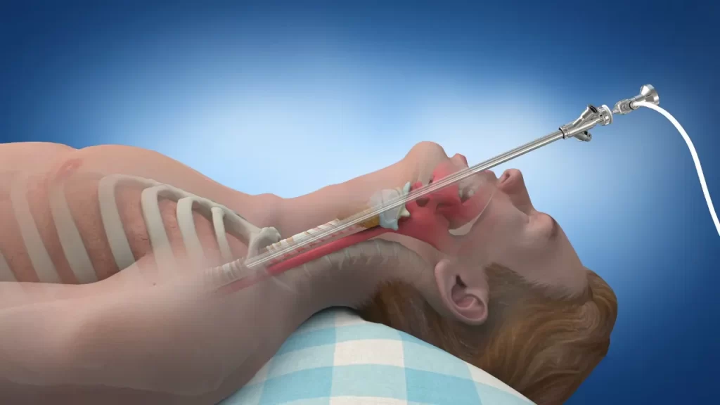 خروج جسم خارجی از ریه