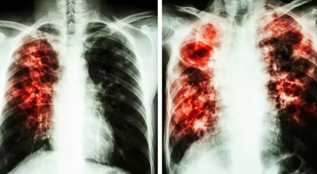 تفاوت فیبروز ریه با سرطان ریه