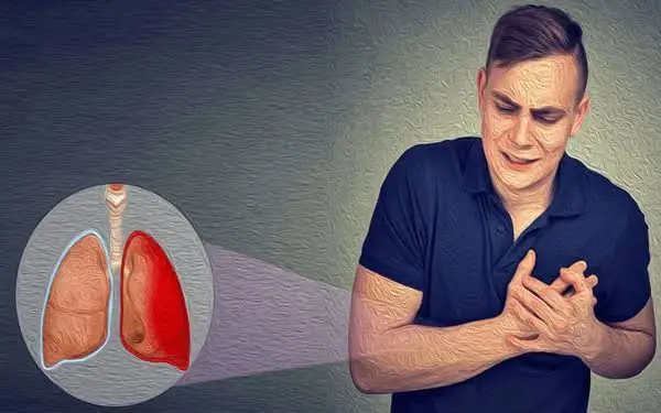 پلورودزیس یا چسباندن پرده جنب بهترین پزشکان ریه در تهران